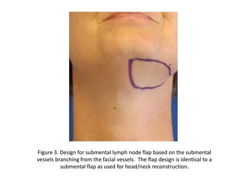 Design For Submental Lymph Node Flap Based On The Submental Vessels