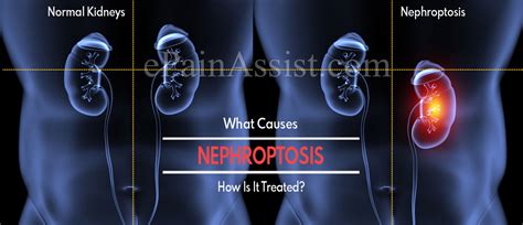 What Causes Nephroptosis And How Is It Treated