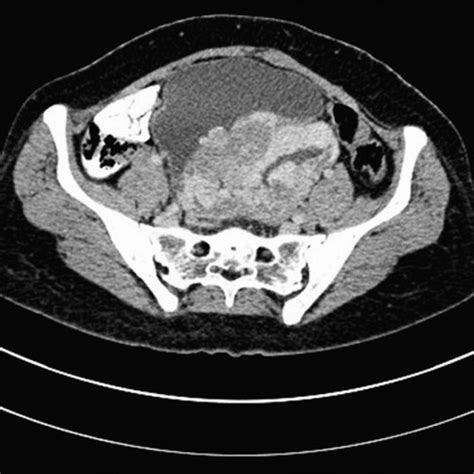 Computed Tomography Ct Scan Showing The Presence Of Anteriorly Placed
