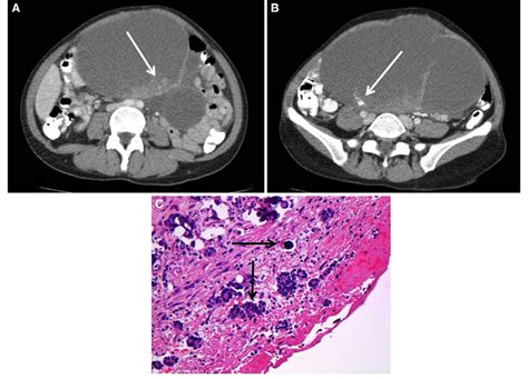Serous Cystadenocarcinoma Of The Ovary Axial Contrast Enhanced Ct