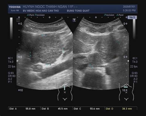 Vietnamese Medic Ultrasound Case 592 Focal Nodular Hyperplasia Of