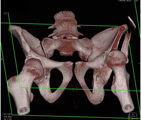 3d Mapping Of Left Acetabular Fracture With Anterior Dislocation