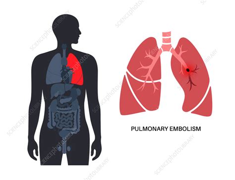 Pulmonary Embolism Illustration Stock Image F0366482 Science