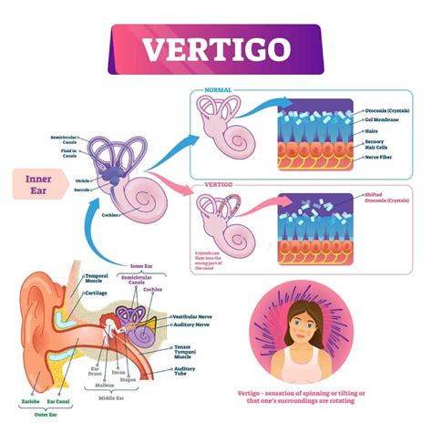 Vertigo Symptoms Ear Crystals Symptoms