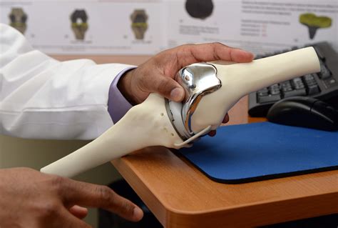 3d Printed Knee Replacement Surgery Enables 85 Year Old Woman To Walk
