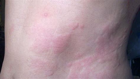 Chronic Hives Chronic Idiopathic Urticaria Causes And Treatment