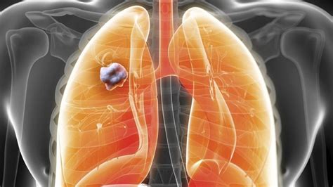Carcinome Du Poumon à Petites Cellules Définition Cause Symptômes