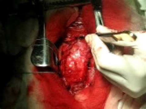 The two layers are separated by a thin slick of fluid that allows the layers to glide easily over each other. Constrictive pericarditis - YouTube