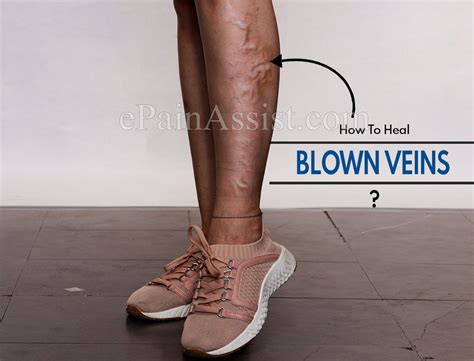 How To Heal Blown Veins Easily And Effectively