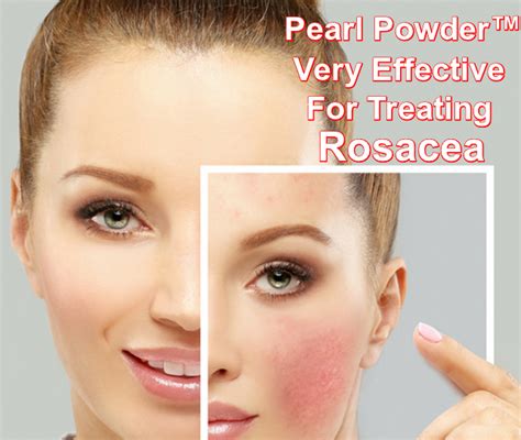Rosacea Is A Chronic Inflammatory Skin Condition And Worsens With Time
