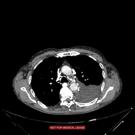 Obstruction of the svc results in one or more collateral. Superior vena cava obstruction | Radiology Case ...