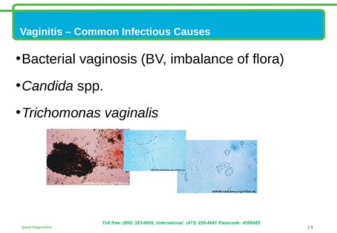 Vaginitis Is It That Simple To Diagnose
