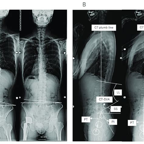 A Preoperative Left And Postoperative Right Frontal Radiographs
