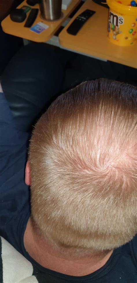 Is My Crown Balding Or Is This Normal With My Hair Colour R