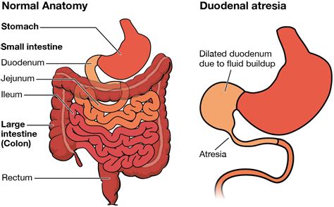 Female Bowel Obstruction Symptoms And Treatment Optio