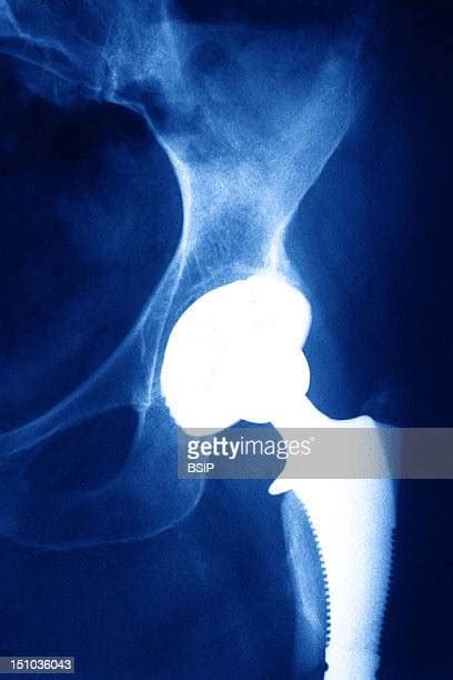 Total Hip Arthroplasty Photos And Premium High Res Pictures Getty Images