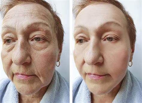Old Woman Wrinkles Before And After Treatments Stock Photo Image Of