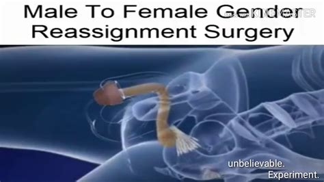 Male To Female Gender Reassignment Surgery Youtube