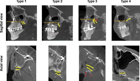 Pattern Of Pterygomaxillary Disarticulation Associated With Le Fort I Maxillary Osteotomy