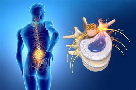 Treatment Options For Your Herniated Disc Franz Jones Do Pain