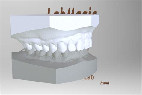 3d Printed Digital Orthodontic Study Models With Virtual Bases By