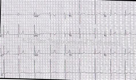 Dextrocardia Ecg Guru Instructor Resources