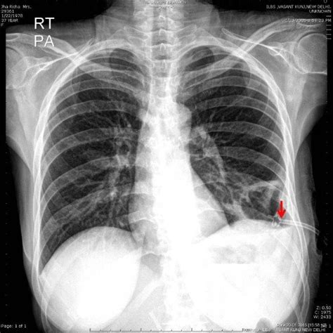 X Ray Chest Showing Intercostal Drainage Tube Drain In Situ Arrow