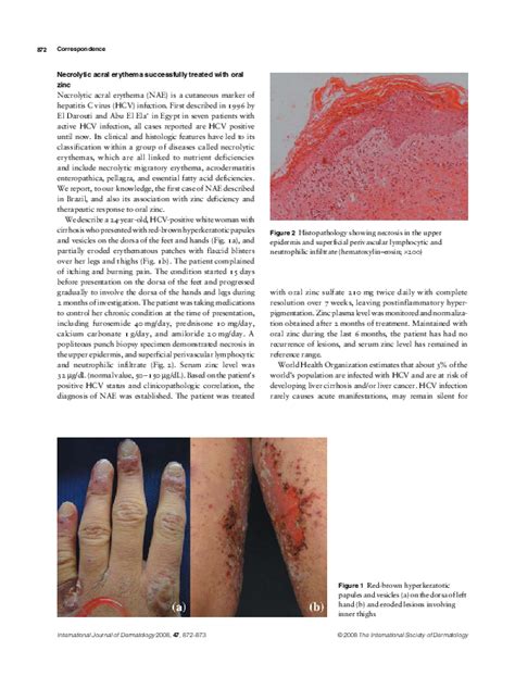 Pdf Necrolytic Acral Erythema Successfully Treated With Oral Zinc