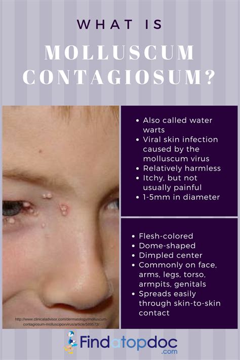 Molluscum Contagiosum Symptoms Causes Treatment And Life Cycle Images