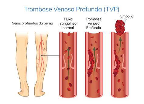 Trombose Venosa Profunda Cid 10