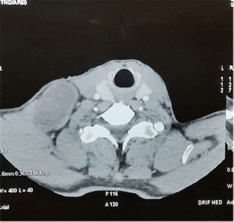 Ct Scan Revealing A Large Well Defined Mass Located In The Right