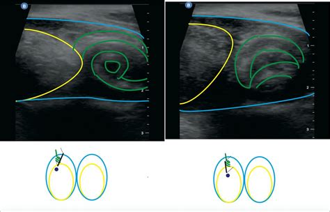 Ultrasonographic ‘whirlpool Sign’ In Testicular Torsion Bmj Case Reports