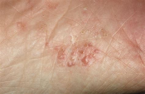 Psoriasis Symptoms Causes Risk Factors And Treatments
