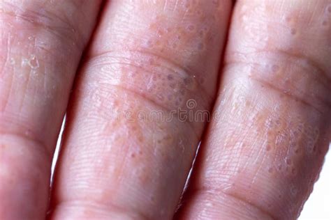 Close Up Atopic Dermatitis On Fingerad Also Known As Atopic Eczema