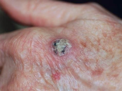 Carcinoma espinocelular Lima Derma Dermatología Oncológica