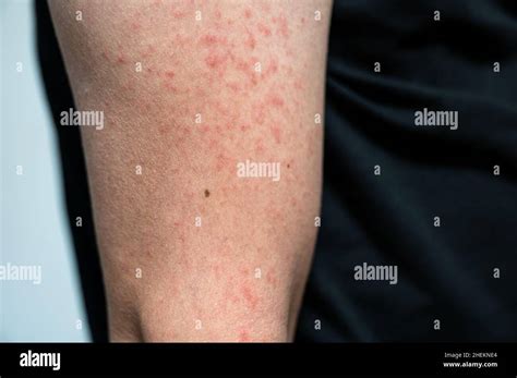 Dermatitis Rash Viral Disease With Immunodeficiency On Arm Of Young