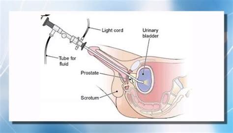 Prostate Surgery Transurethral Resection Of The Prostate Turp