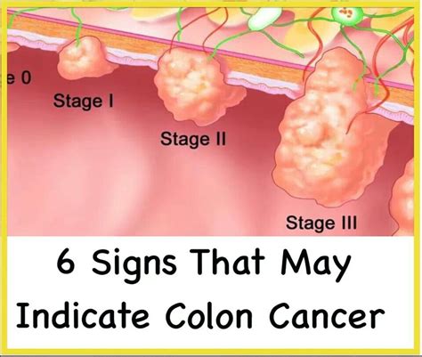 Colon Cancer Signs And Symptoms Of Colon Cancer