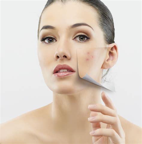 Laser And Light Treatment For Adult Acne Clear Clinic