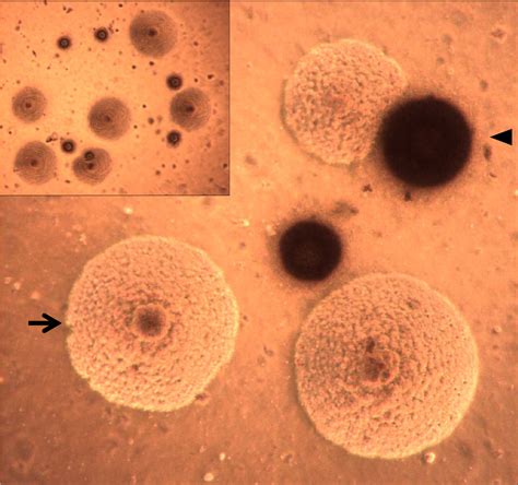 Ureaplasma Urealyticum Et Mycoplasma Hominis Mycoplasme Ureaplasma Urealyticum Traitement