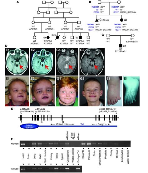 Jci Mutations In Kif7 Link Joubert Syndrome With Sonic Hedgehog