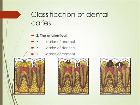 Dental Caries And Pulpitis презентация онлайн