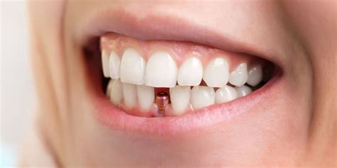 Prix Pose Implants Dentaires Pas Cher Tunisie Couronne Dentaire