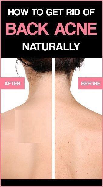 How To Get Rid Of Back And Shoulder Acne Fast Acne Fast Rid