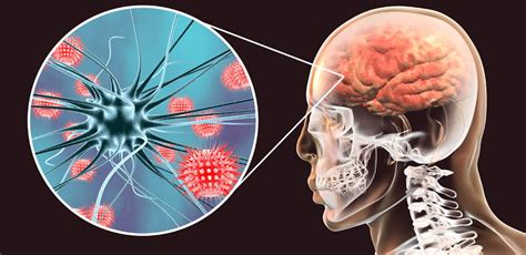 Meningitis Qué Es Síntomas Tratamiento Y Prevención