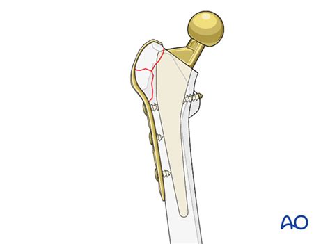 Compression Plate And Screw Fixation For Trochanteric Femoral Fracture