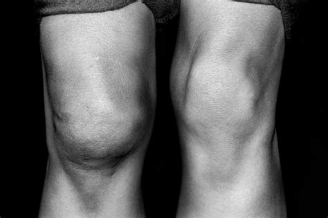 What Causes Knee Swelling With Pictures