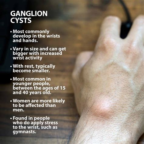 Ganglion Cyst Wrist Treatment Florida Orthopaedic Institute
