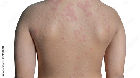Urticaria Or Hives On Child Back With Clipping Paths Stock Photo