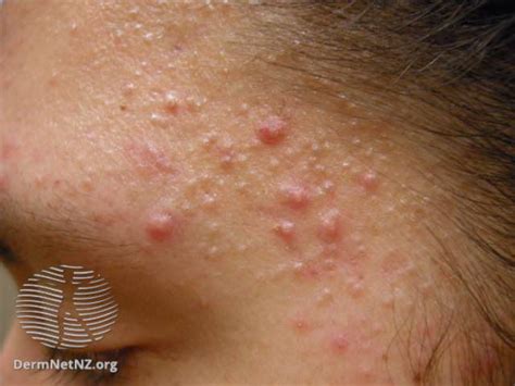 Overview Of Sebaceous Glands And Your Skin